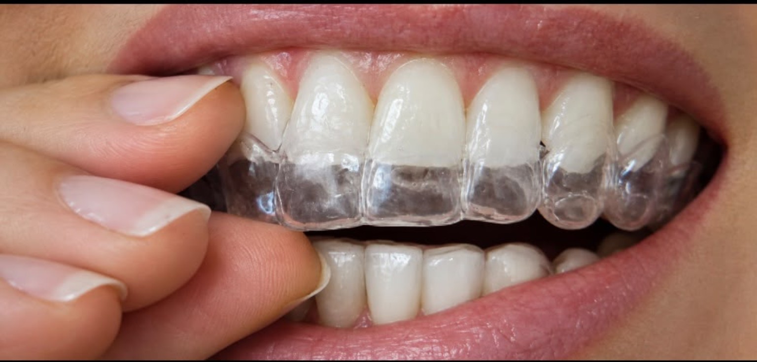 Transparente Schiene für das Bleaching zu Hause